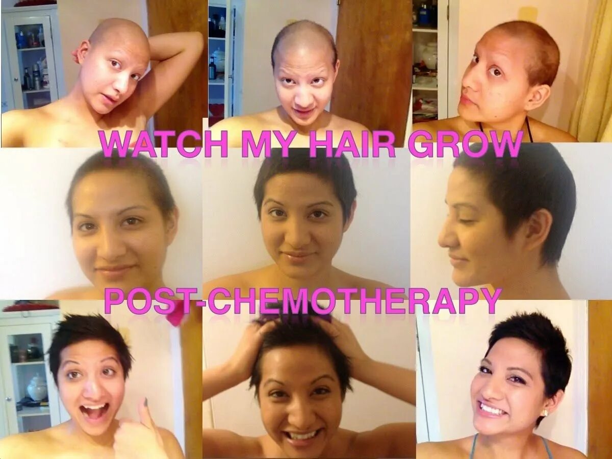 Рост волос после химиотерапии. Волосы после химиотерапии. Стрижки на отросшие волосы после химиотерапии. Волосы после химиотерапии по месяцам.
