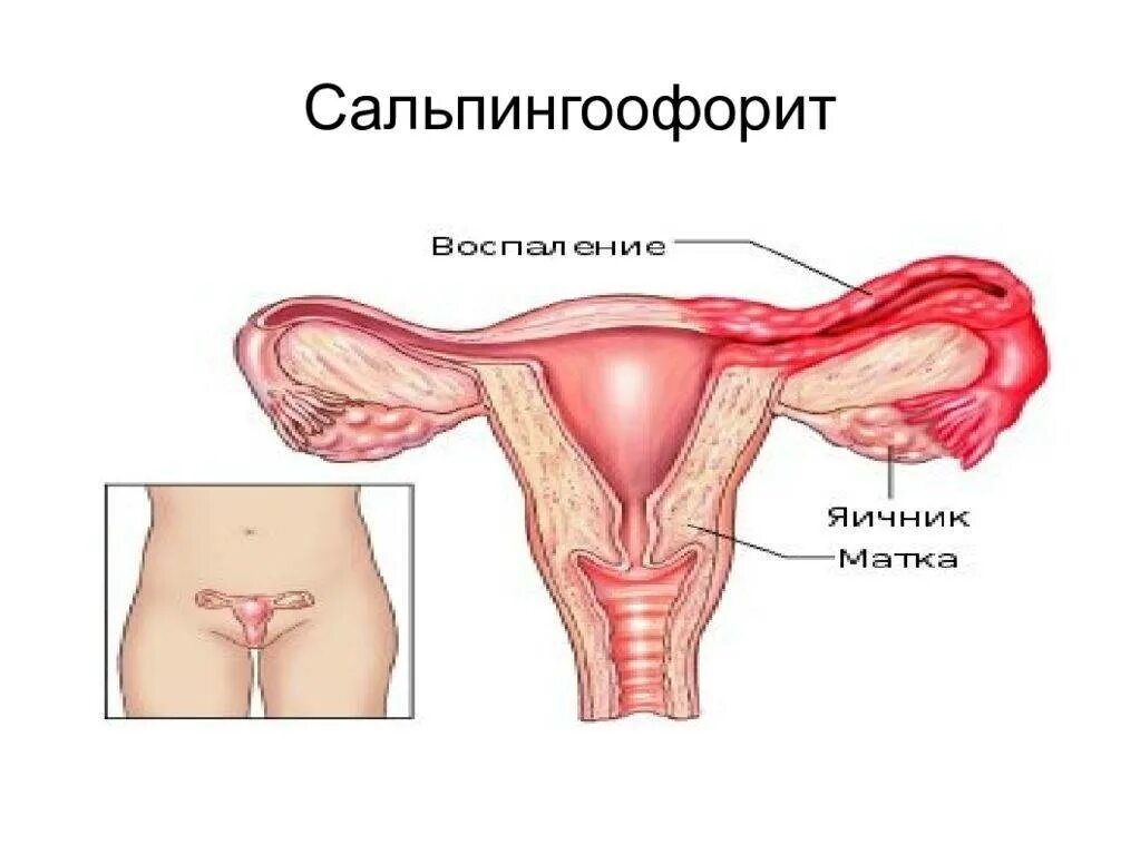 Сальпингит и оофорит что это. Сальпингит и сальпингоофорит. острый сальпингоофорит и оофорит. второй этап. послеродовой сальпингоофорит. хронический сальпингоофорит симптомы.