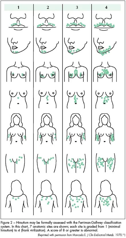 В каком возрасте начинают расти волосы. Ферримана Голлвея. Гирсутизм шкала Ферримана. Шкала Ферримана Голлвея. Гирсутизм по шкале Ферримана.