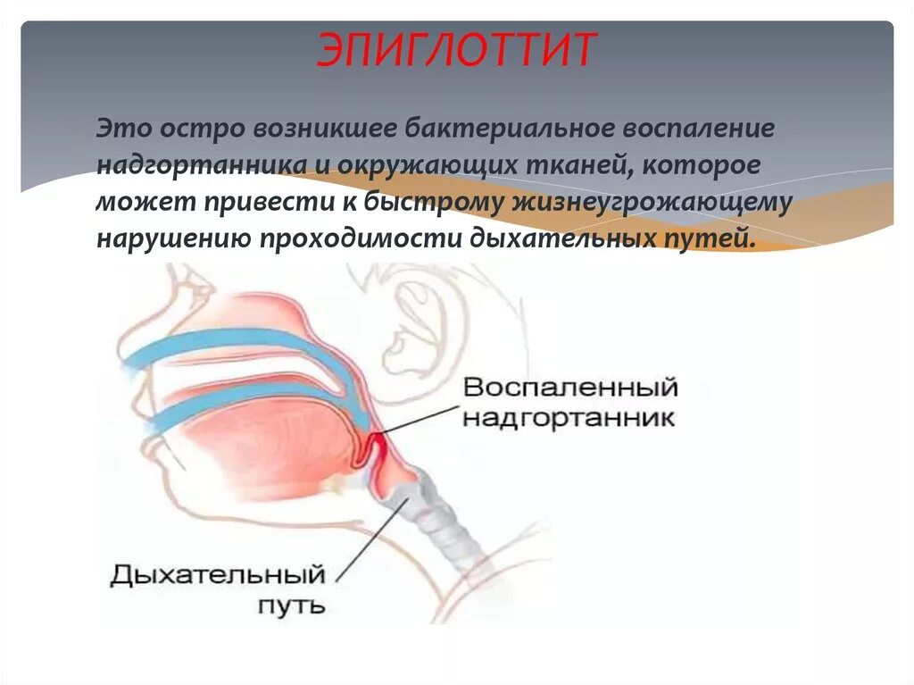 Эпиглоттит симптомы. Бактериальный эпиглоттит. Эпиглоттит надгортанник. Эпиглоттит воспаление надгортанника. Воспаление над гортаника.