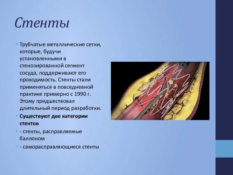 Срок стентирования. Баллонная ангиопластика артерий нижних конечностей. Атеросклероз коронарных артерий. Стентирование коронарных артерий.