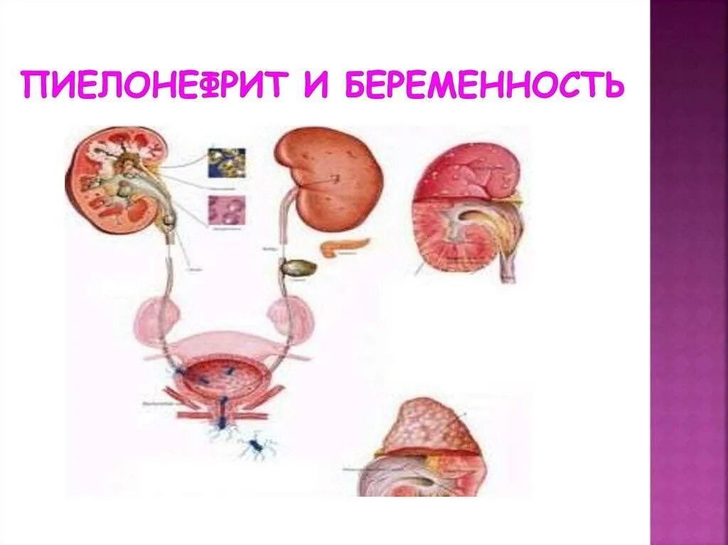Пиелонефрит 1 триместр. Пиелонефрит и беременность. пиелонефрит почек при беременности. гломерулонефрит и беременность. изменения почек при беременности.