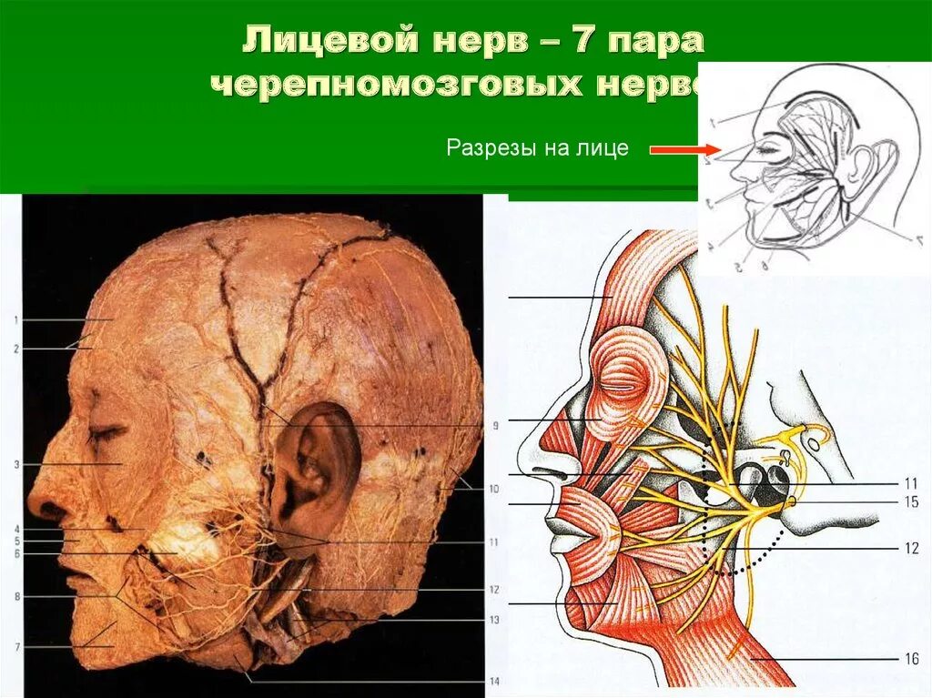 Карта лицевых нервов. Лицевой нерв ЧМН. Лицевой нерв 7 пара ЧМН. Лицевой нерв анатомия топография схема. Расположение ветвей лицевого нерва.