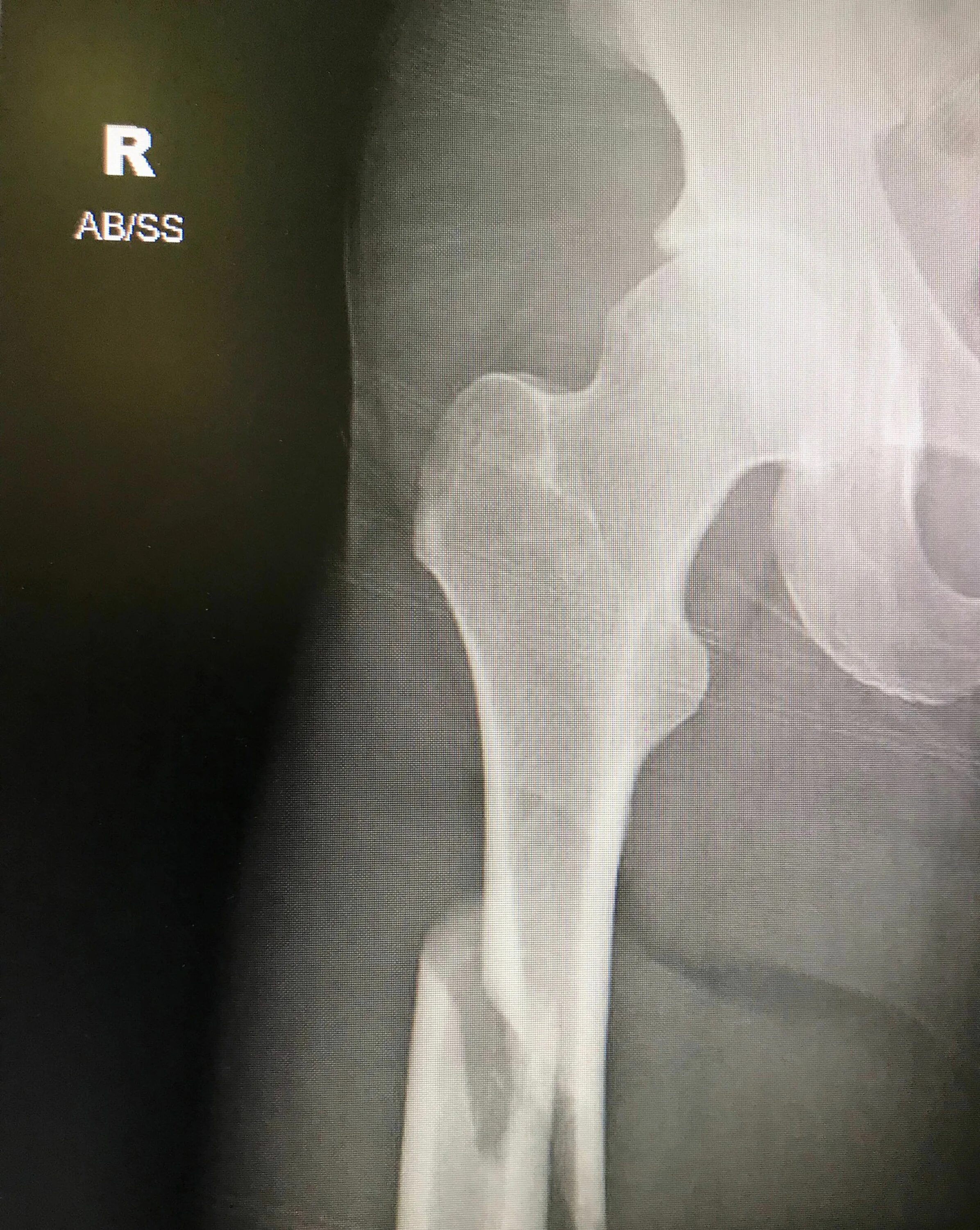 чрезвертельные переломы остеосинтез. чрезвертельный перелом бедренной кости рентген. перелом бедренной кости со смещением рентген.