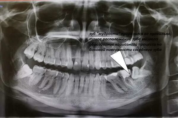 Снимок зубов видное. Ортопантомограмма кариес. Ортопантомограмма пульпит. Пародонтоз ортопантомограмма.
