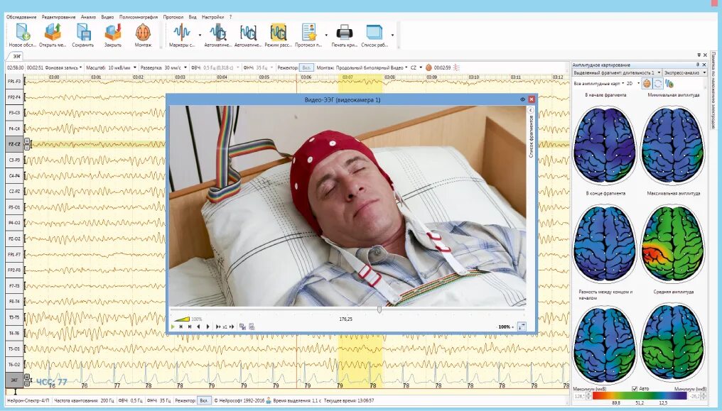 Ээг 2 часа. ЭЭГ мониторинг головного мозга. ЭЭГ Нейрон спектр. ЭЭГ ночной сон видеомониторинг. Электроэнцефалограф Нейрон-спектр-4/п.