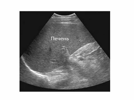Узи печени воронеж