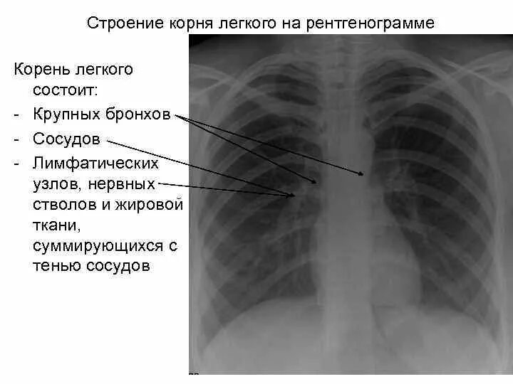 Будет расширена тем самым. Патология корня лёгкого на рентгенограмме. Синдром патологии корня легкого. Синдром инфильтрации корня легкого рентген.