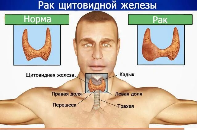 После железа. Операция щитовидной железы. Операция на щитовидную железу. После операции щитовидной железы. Опухоль щитовидной железы операция.