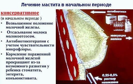 Нелактационный Гнойный мастит. Мастит воспаление молочных желез. Консервативная терапия при мастите.