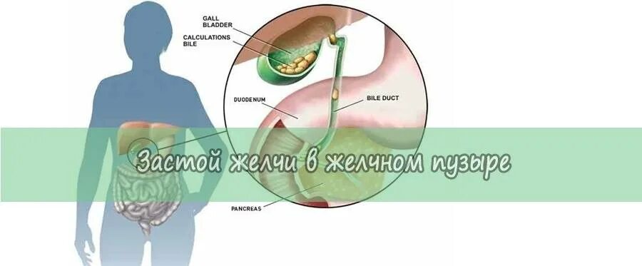 Как разжижать желчь в желчном пузыре. Застой желчи в желчном пузыре. Застойный желчный пузырь. Застойные явления в желчном пузыре.