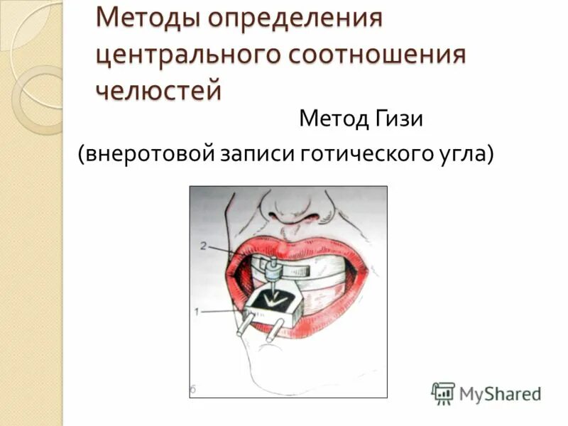 Методика определения центрального соотношения. Методика определения центрального соотношения
