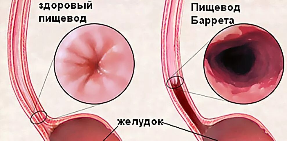 С г пищевода. Пищевод Барретта дисплазия.