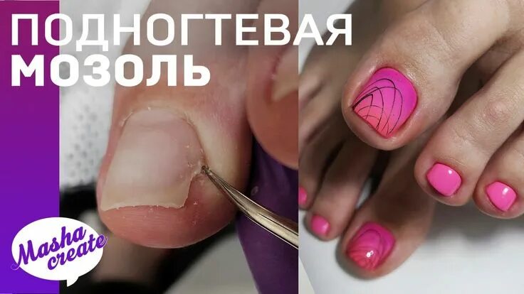 Подногтевая мозоль на ногах как выглядит лечение Подногтевая меланома Вопрос дерматологу 03 Онлайн