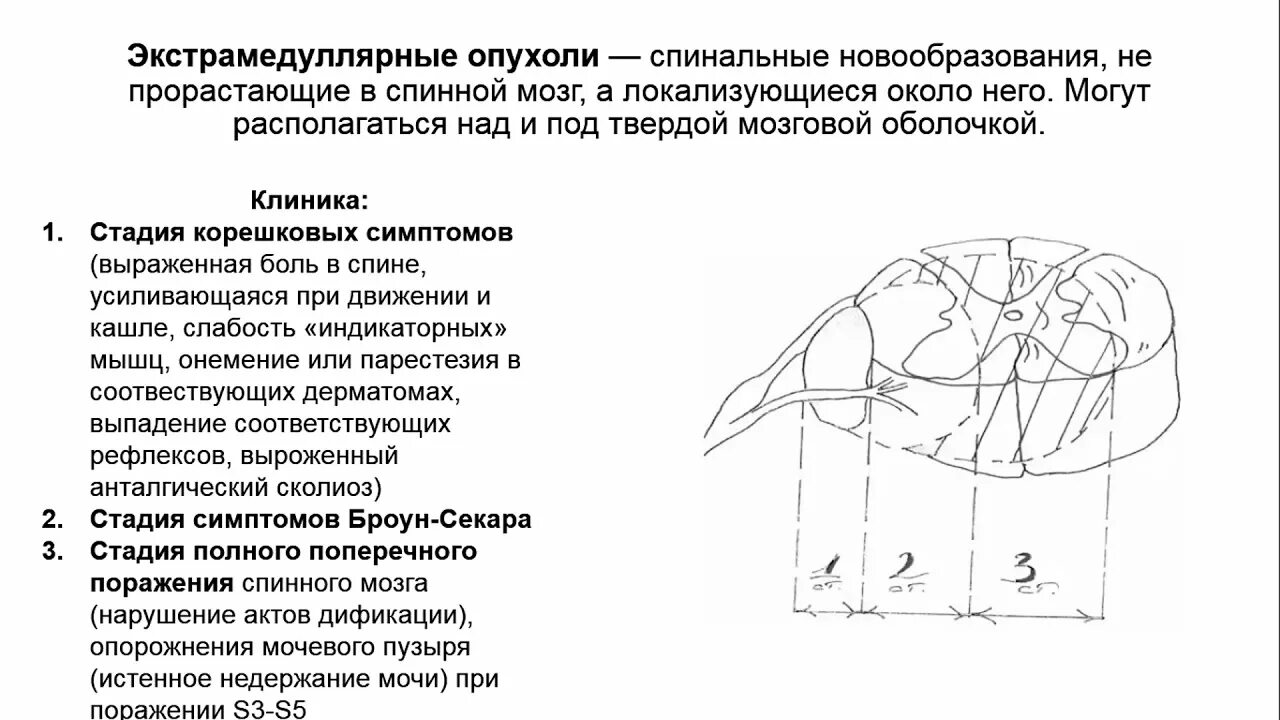 Классификация экстрамедуллярных опухолей. Интрамедуллярная и экстрамедуллярная опухоль спинного мозга. Классификация образований спинного мозга. Клиническая картина опухолей спинного мозга. Интрамедуллярные опухоли спинного