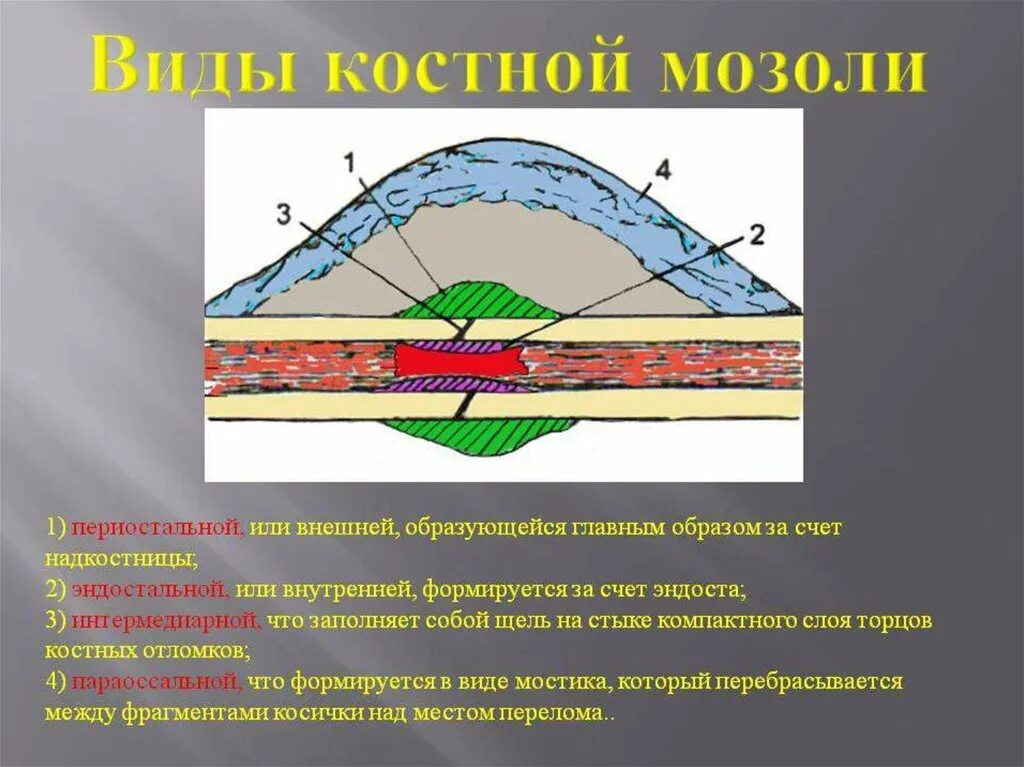 Фазы формирования костной мозоли. Параоссальная костная мозоль. Формирование первичной костной мозоли. Стадии формирования костной мозоли. Внутренним слоем и поверхностью