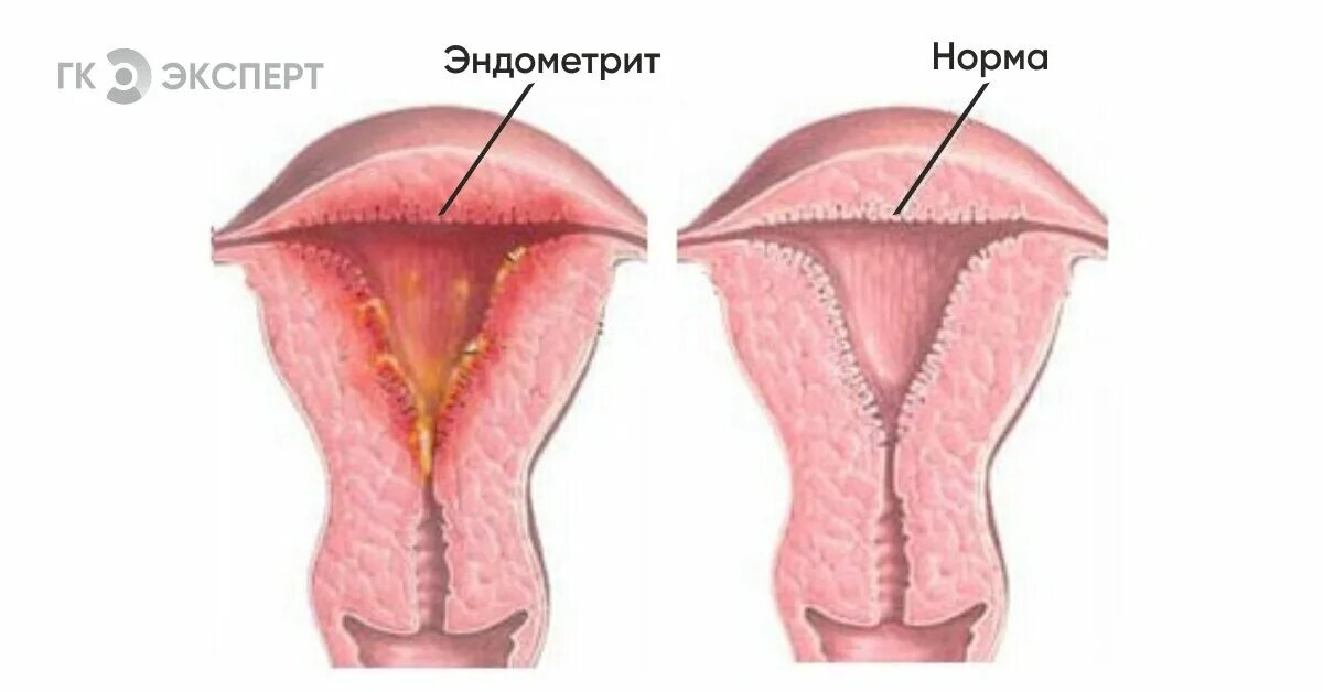 Со эндометрий. Эндометриалны гиперплазия. Слизистая оболочка матки.