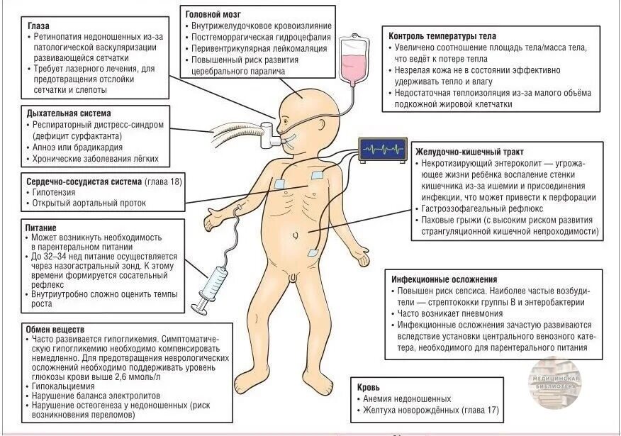 Опн новорожденных. Последствия недоношенности. Последствия недоношенности ребенка. Внешние признаки недоношенных. Причины развития недоношенности.