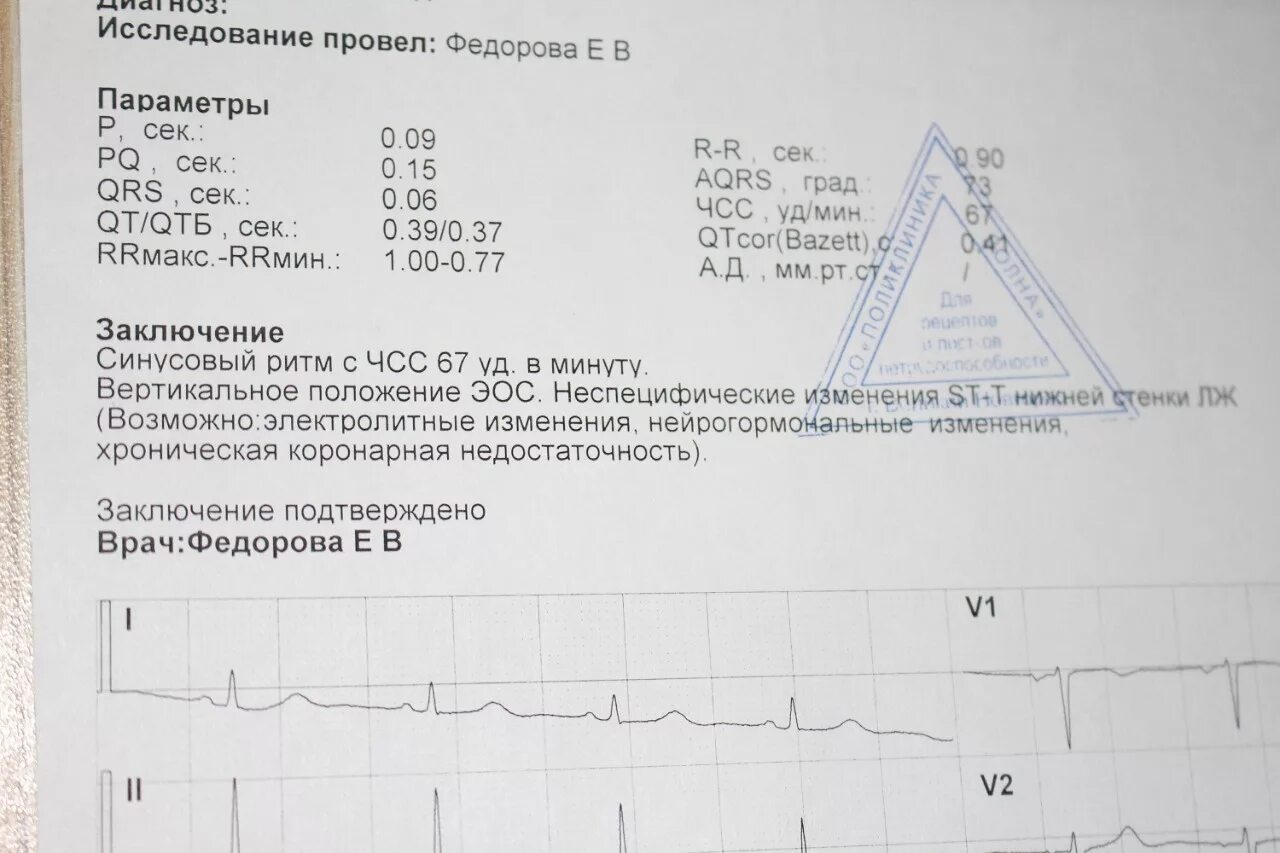 Образец ЭКГ С заключением норма. Образец расшифровки ЭКГ норма. Заключение по ЭКГ В норме. Расшифровка ЭКГ В норме заключение. Заключения экг примеры