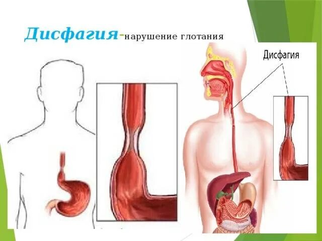 Дисфагия – это нарушение глотания:. Пищевод вещества