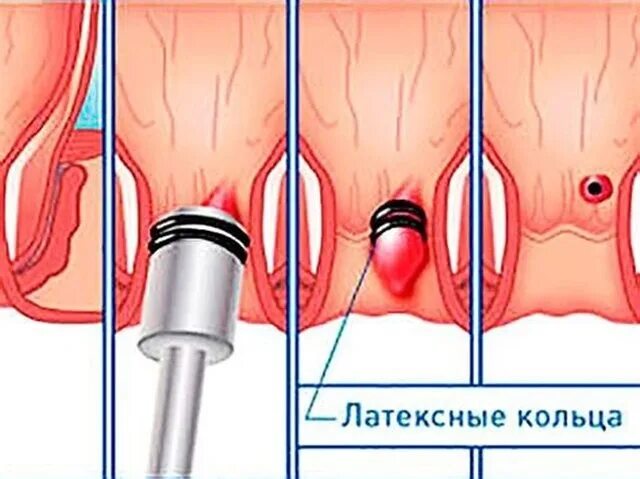 Вакуумное лигирование геморроя. Лигирование латексными кольцами. Латексное лигирование геморроя. Вакуумное латексное лигирование. Малоинвазивное лечение геморроя