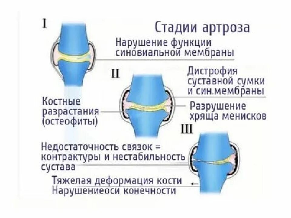 Деформирующий артроз коленного сустава схема. Схема развития деформирующего остеоартроза. Стадии деформирующего артроза. Лечение суставов методики