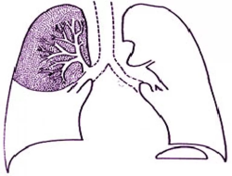 Спадение бронха