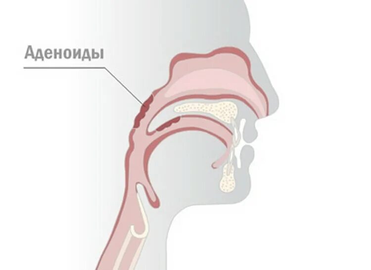 Аденоиды свод носоглотки. Что такое аденоиды в носоглотке у ребенка. Глоточная миндалина аденоиды.