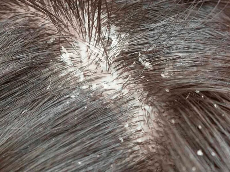 Сильная перхоть что делать. Dandruff псориаз. Асбестовидный себорейный дерматит.