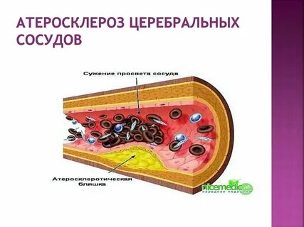 Церебральный атеросклероз
