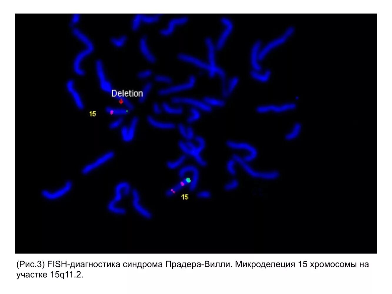 Миллера дикера. Микродиляционные синдромы. Микроделеционный синдром. Метод диагностики микроделяционных синдромов.