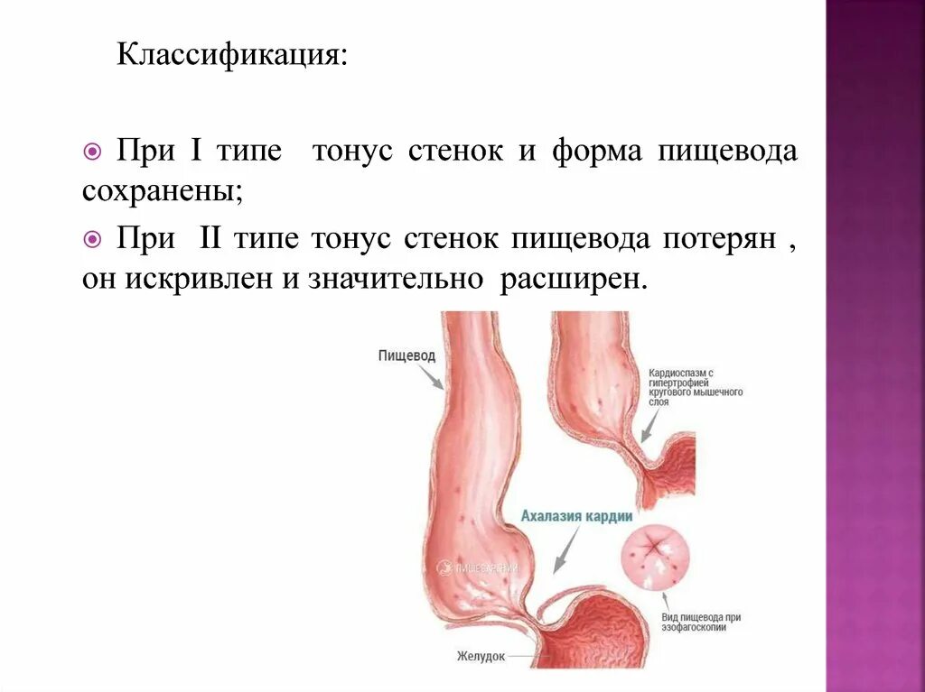 Халазия пищевода. Ахалазия пищевода классификация. Ахалазия кардии и кардиоспазм. Ахалазия кардии эндоскопическая классификация.