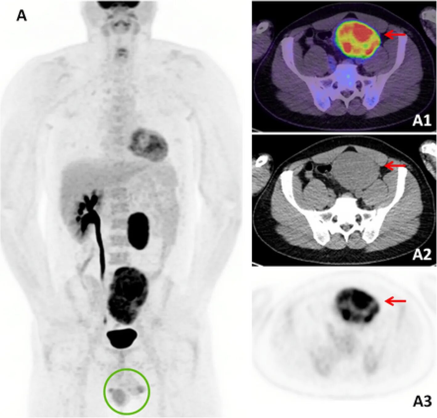 ПЭТ/кт Discovery Pet/CT 610. ПЭТ кт с 18f-флюородезоксиглюкозой.