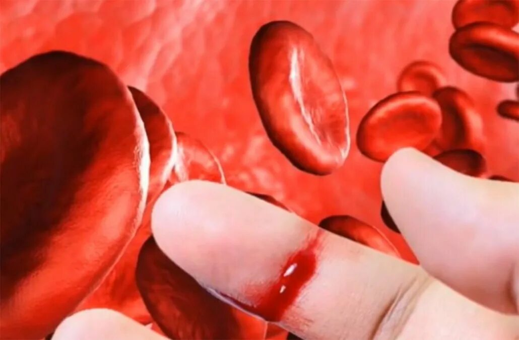 Кровотечение у взрослых. Острая кровопотеря фото. кровоточивость сосудов. внутреннее кровотечение фото. периферическая кровь при гемофилии.