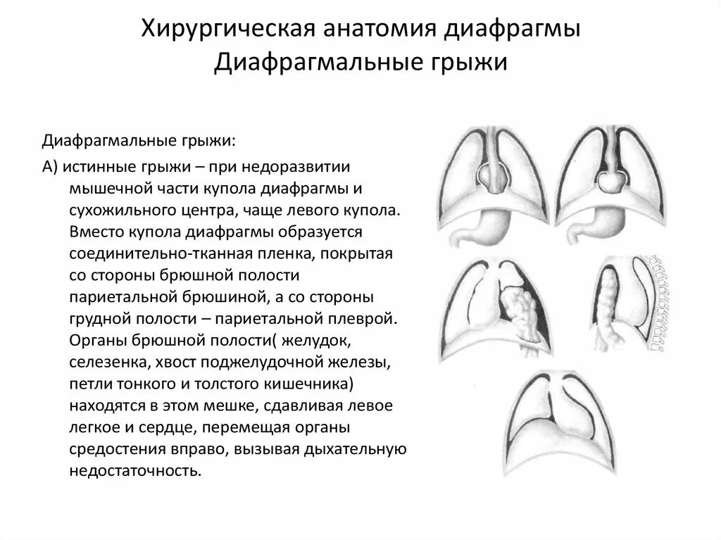 Релаксация купола диафрагмы что это такое. Грыжа левого купола диафрагмы. Грыжа купола диафрагмы кт. Грыжа правого купола диафрагмы. Диафрагмальная грыжа купола диафрагмы.