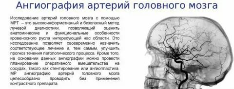 Ангиография головного мозга что это