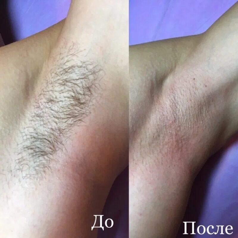 Лазерная эпиляция. После диодного лазера когда начинают выпадать волосы. Волосы после лазерной эпиляции. Через сколько после эпиляции выпадают волосы. Волосы после первой процедуры лазерной эпиляции.