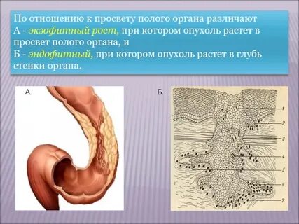 Экзофитный рост опухоли