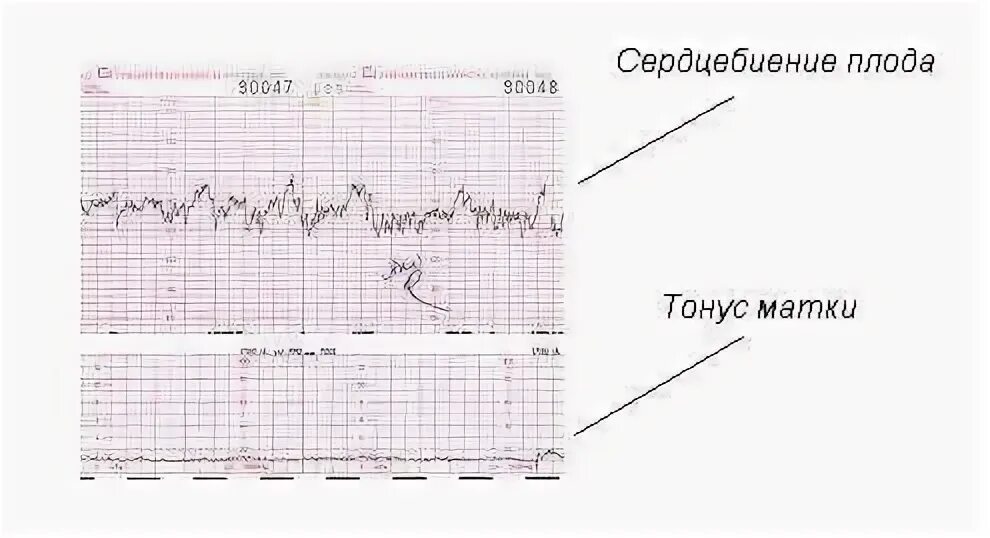 КТГ при беременности схватки расшифровка. Как выглядят схватки на КТГ В 39. Тренировочные схватки на КТГ как выглядят. КТГ В родах показатели схваток. 40 неделя беременности нет схваток