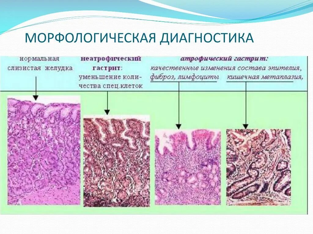 Морфологические изменения болезни. Морфология хронического гастрита. Хронический атрофический гастрит морфология. Атрофический гастрит патанатомия. Морфологическая диагностика.