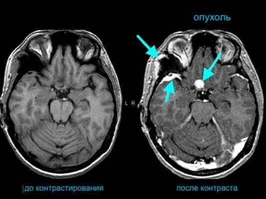 Разница кт и кт с контрастом. Мрт головного мозга контрастирование. Кт томограмма головного мозга. Контрастное мрт. Мрт головы с контрастом.