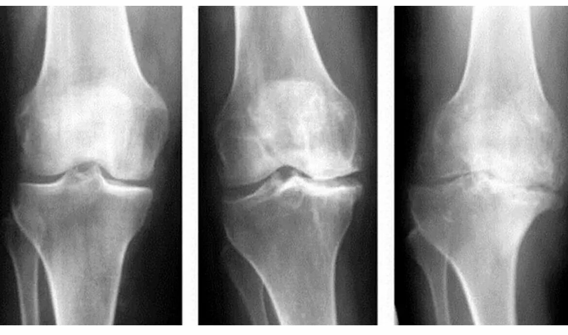 Асептический некроз мыщелка бедренной. Kellgren Lawrence артроз коленного. Остеоартроз (деформирующий остеоартроз). Остеоартроз коленного сустава рентген. Артрозо-артрит коленного сустава рентген.
