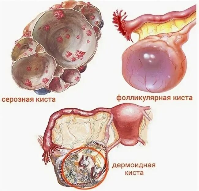 Как образуется киста. Эндометриоидная киста яичника. папиллярная цистаденома яичников. геморрагическая фолликулярная киста яичника. липоидная киста яичника.
