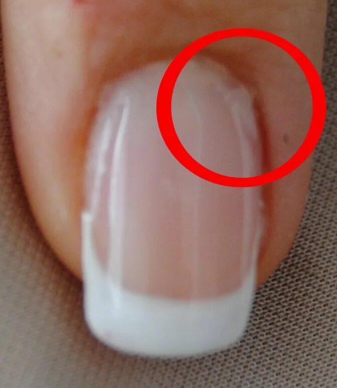 Почему появляются отслойки. Онихолизис у основания ногтя.