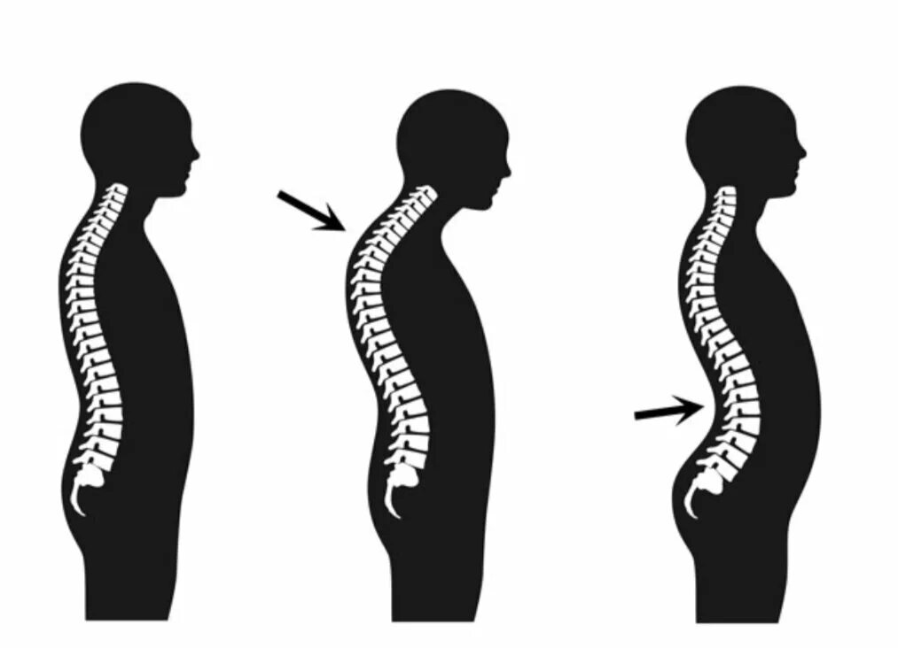 Щенок по имени лордоз. Кифоз позвоночника. Кифоз грудного отдела позвоночника. Кифоз осанка человека.