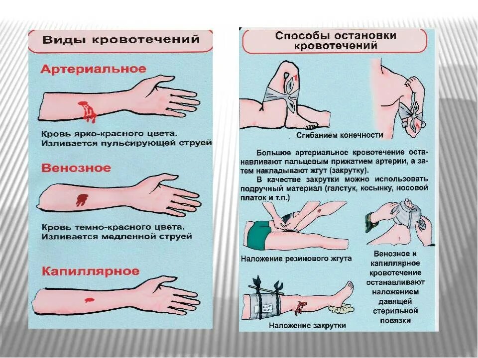 Тест определите кровотечение. Способы остановки кровотечений артериальное венозное капиллярное. Методы остановки крови при артериальном кровотечении. Виды РАН, виды кровотечения и способы остановки кровотечения. Способы остановки артериального и венозного кровотечения.