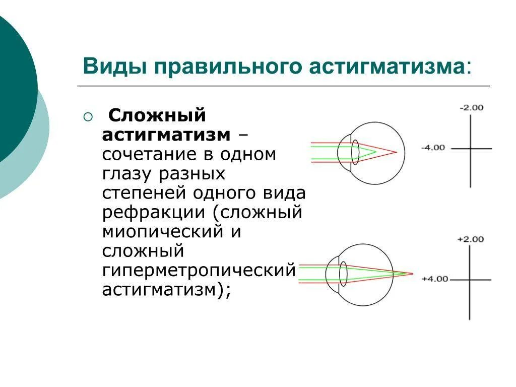 Что такое сложный миопический астигматизм. Сложный близорукий астигматизм обоих глаз. Сложный гиперметропический астигматизм 2 степени. Сложный прямой гиперметропический астигматизм 1 степени. Сложный прямой гиперметропический астигматизм у детей.