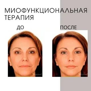 Миофункциональный логопед