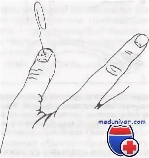Перелом пальца бугристости ногтевой. Ампутация дистальной фаланги пальца кисти. Признаки трещины в фаланге пальца. Оскольчатый перелом фаланги пальца.