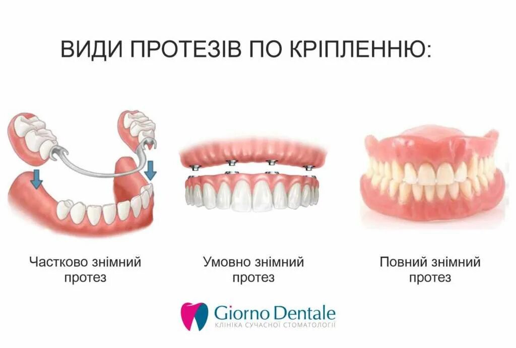 Типы протезирования зубов. Классификация съемных протезов. Как крепятся съемные